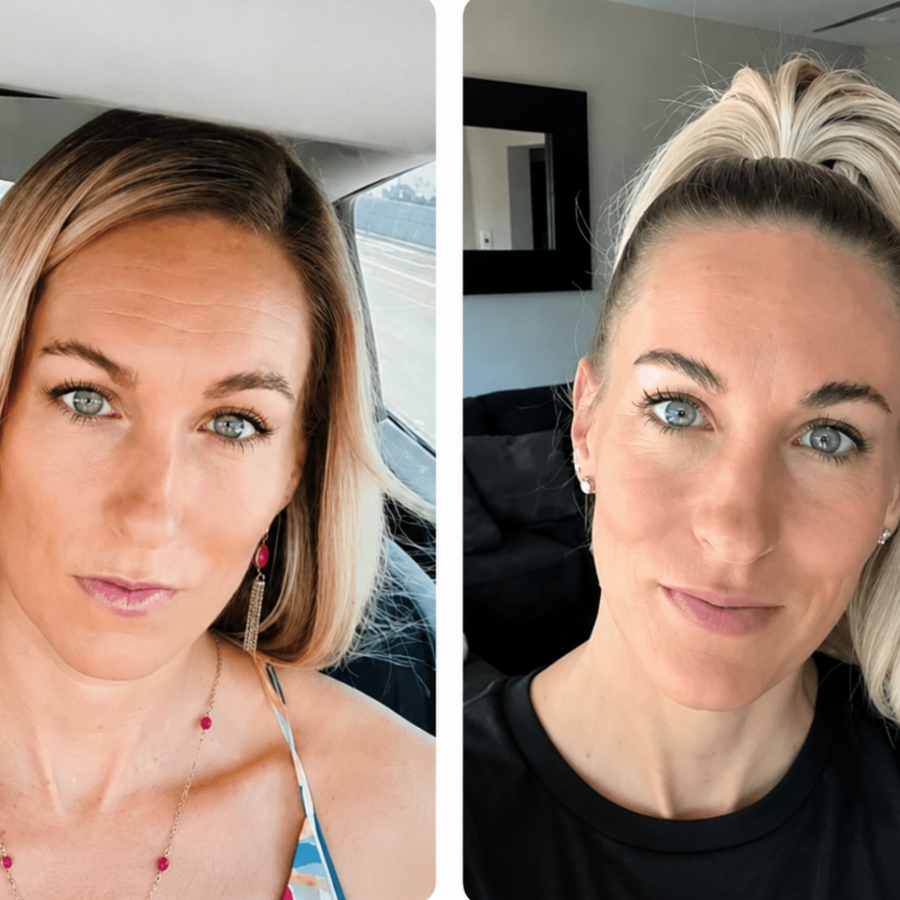 En bild före och en bild efter på kvinna som har använt Frownies.