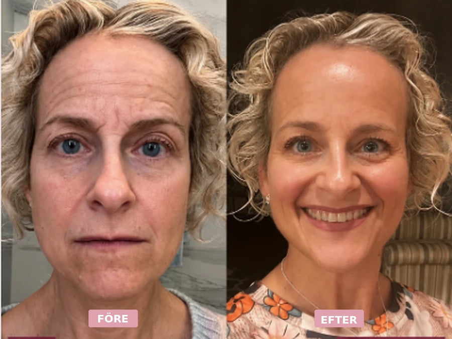 Före och efter-bild på kvinna som använder Frownies ansiktsplåster, med synlig skillnad i ansiktets fina linjer.