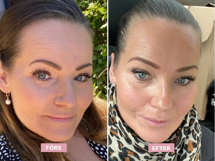 Före och efter-bild på kvinna som använder Frownies ansiktsplåster, med synlig skillnad i pannans och ansiktets linjer.