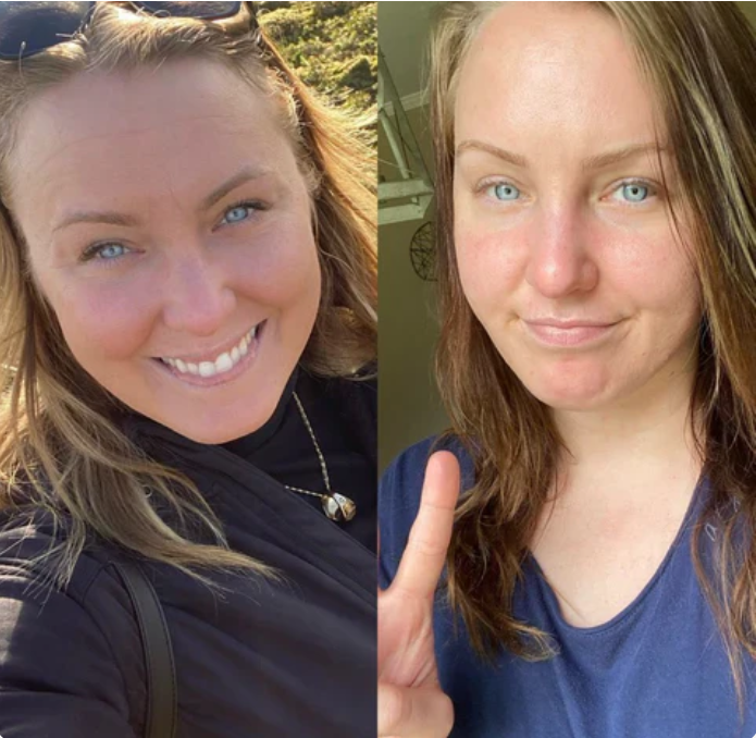 Före- och efterbild av kvinna som visar förändring i pannans fina linjer efter användning av Frownies